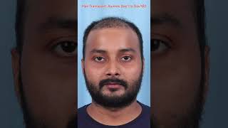 Hair Transplant Results Day 1 to Day 180 #shorts #hairtransplant 7426859490 WhatsApp