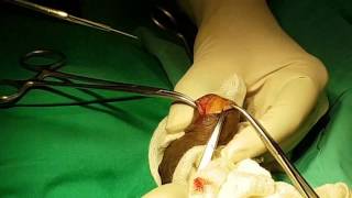 Urethral Stone removal