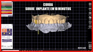 Coroa Sobre implante  [Do Zero ao Avançado]