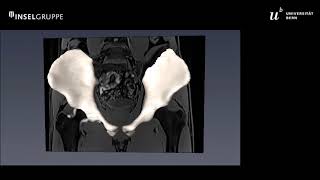 Automatic 3D-MRI hip segmentation – the future? | Simon Steppacher (Session 1)