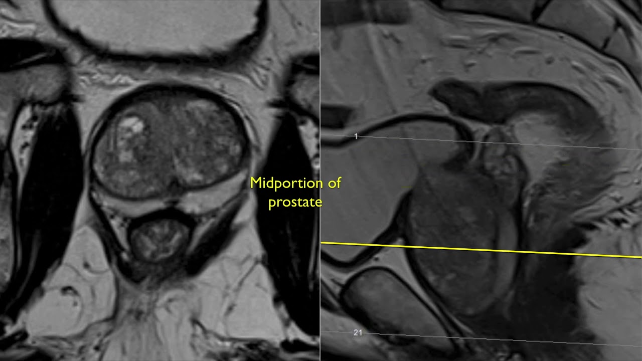 Prostate Anatomy Mri