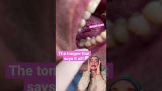 Nothing smooth about this tongue! 😱💥 #shorts #viral #teeth #short