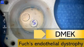 DMEK Corneal Transplant - Management of Fuch's Endothelial Dystrophy