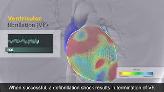 Defibrillation clinical animation