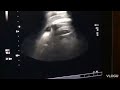 a case of cloverleaf appearance of fetus head on ultrasound