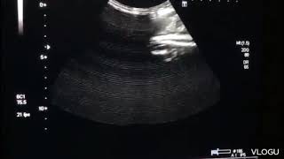 A case of cloverleaf  appearance ( of fetus head )on ultrasound