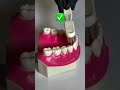 La técnica correcta o forma de cepillar tus dientes es esencial para el cuidado de tus dientes