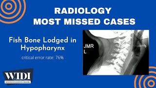 Most Missed Cases: Fish Bone Lodged in Hypopharynx