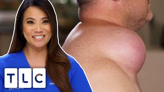 Dr Lee Removes A Giant Lipoma From This Man's Shoulder | Dr Pimple Popper