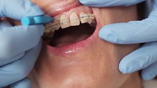 How to clean your around your braces with Gill from Elmsleigh House Dental Clinic