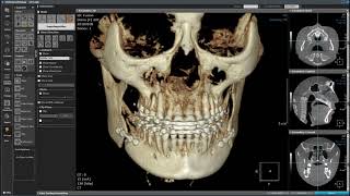 3D Ceph Module Superimposition