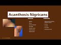 Acanthosis Nigricans - What is Acanthosis Nigricans & What are its CAUSES?