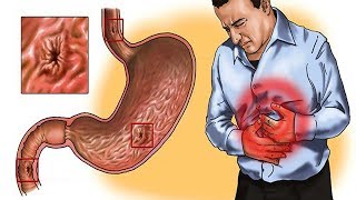 5 Effective Home Remedies for Gastritis