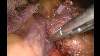 Laparoscopic distal panceatectomy (pancreas) with spleen preservation Dr Ravula Phani Krishna