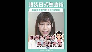 眼袋改善前後對比，不動刀改善！｜眼袋淚溝專家｜淚溝 眼袋 黑眼圈 微整｜眼袋消除｜新竹眼袋｜新竹淚溝｜新竹玻尿酸｜黑眼圈改善｜新竹醫美 微依美精品醫美診所｜黑眼圈醫美