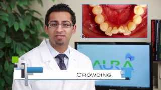 Braces: Common Cases, Crowding, Under Bite, Cross Bite - Aura Orthodontics