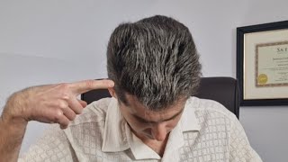 Finasteride Vs Minoxidil for hair loss