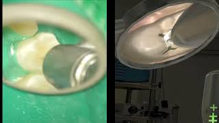 Maxillary Premolar: Clinical vs Simulation Comparison