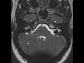 vascular loop in iac