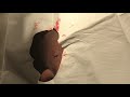 epidermoid cyst extraction dr. steven greene in seattle