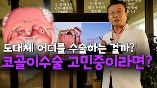 코골이 수술 과연 얼마나 효과가 있을까??