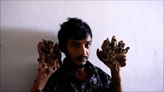 Bangladesh "Tree Man" wants hands amputated to relieve pain | AFP