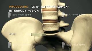 ALIF - Lumbar Spine Surgery
