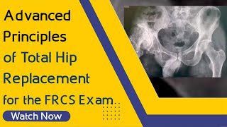 Advanced Principles of Total Hip Replacement for the FRCS Exam | Orthopaedic Academy