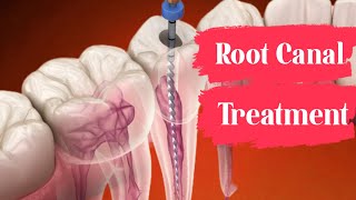 Root canal retreatment#dentist #satisfying #rootcanal #dentaltreatment#dentaltreatment