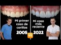 Carillas dentales en el 2022 ¿Qué ha cambiado y por qué son mejores ahora?