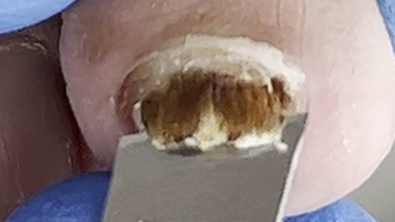 Gentle pedicure: treatment of onychomycosis【Xue Yidao】