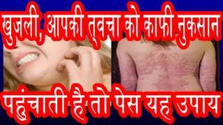 खुजली से हों परेशान, तो पेश है यह ऊपाय Irritating itch, then this measure is introduced || allergy