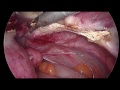 laparoscopic total hysterectomy using in bag morcellation