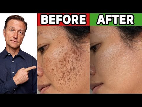 How do you get rid of hormonal pigmentation?