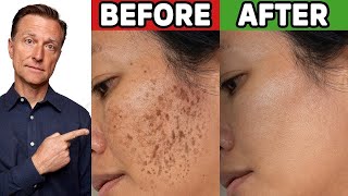 How to Get Rid of Hyperpigmentation (Aging or Dark Spots)