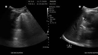 Gallbladder Stones AND Polyps