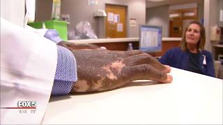 As vitiligo changes his skin, doctor shares story