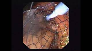 Metal Stenting For-Malignant obstructive jaundice (MOJ).