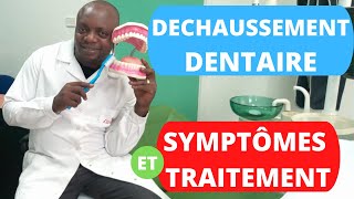 Le traitement de déchaussement des dents: comment trouver la solution au déchaussement dentaire?