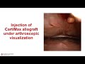 modified low flow arthroscopic sandwich technique for complex osteochondral lesions of the talus