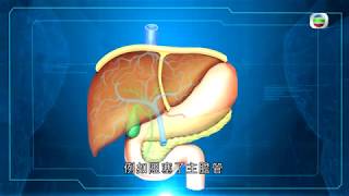 癌症系列 III   膽管癌   謝耀昌醫生