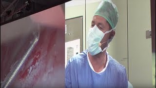 Live Surgery  - Bladder Tumour Resection
