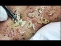 Big Blackheads Extraction from Cheeks - Best Pimple Popping videos