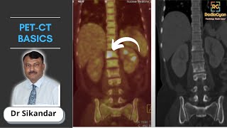 PET-CT Basics | Nuclear Medicine | Dr. Sikandar