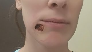 'Blackhead' on Woman's Chin Turned Out to Be Skin Cancer