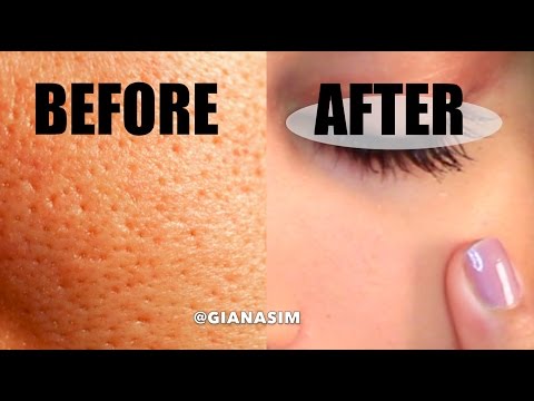 D.I.Y - Get rid of LARGE Pores NATURALLY! IT WORKS! D.I.Y - Get rid of LARGE Pores NATURALLY! IT WORKS!