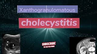 Xanthogranulomatous cholecystitis, ultrasound cholecystitis, echography cholecystitis,