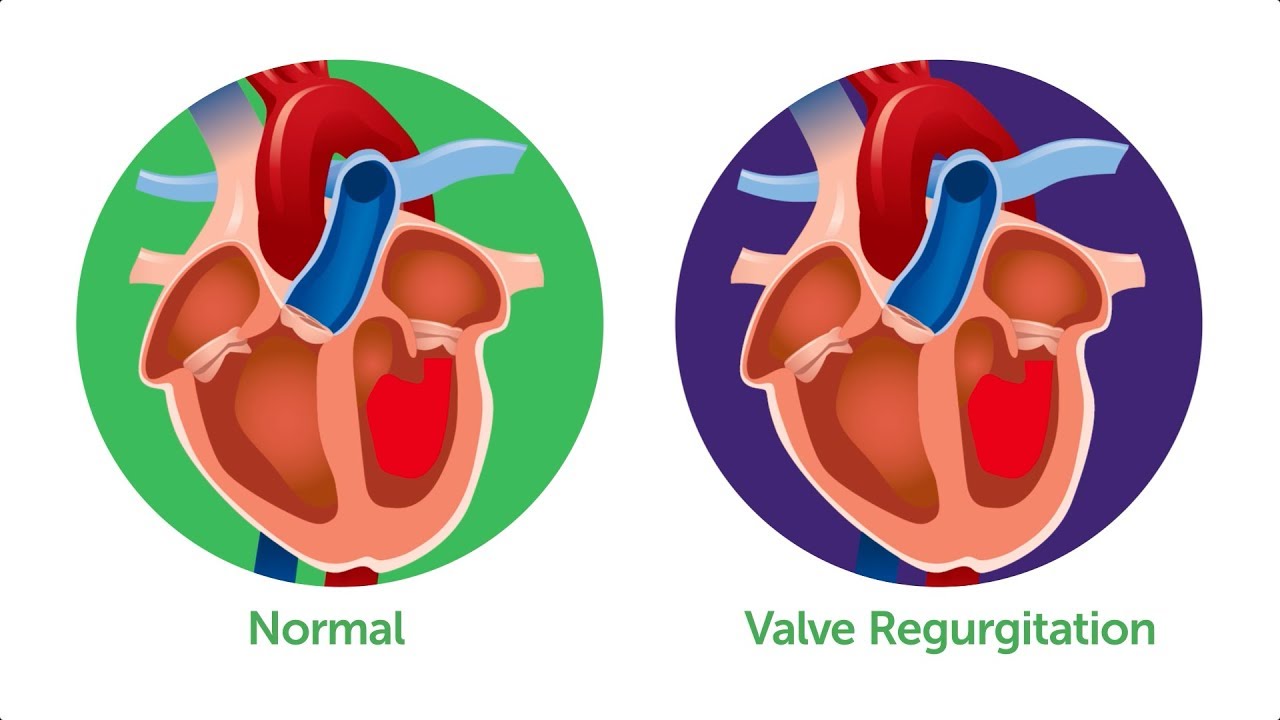 Learn About Heart Valve Disease - YouTube