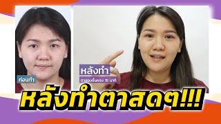 สดกว่านี้ก็ Live แล้ว รีวิวตาสองชั้นหลังทำทันที ธีรพรคลินิก คุณหมอชลธิศ