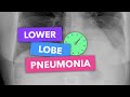 Lower lobe pneumonia - Radiopaedia's Emergency Radiology Course